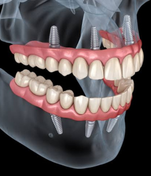 Prótese protocolo sobre implantes dentários em Sorocaba na clínica Harmodont